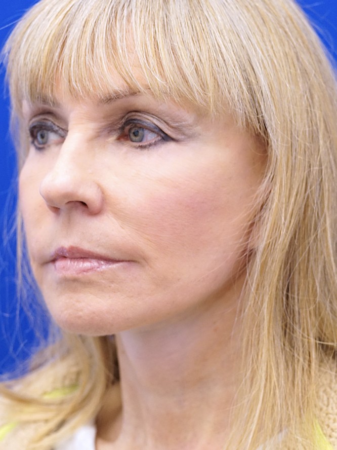 Neck Rejuvenation — After