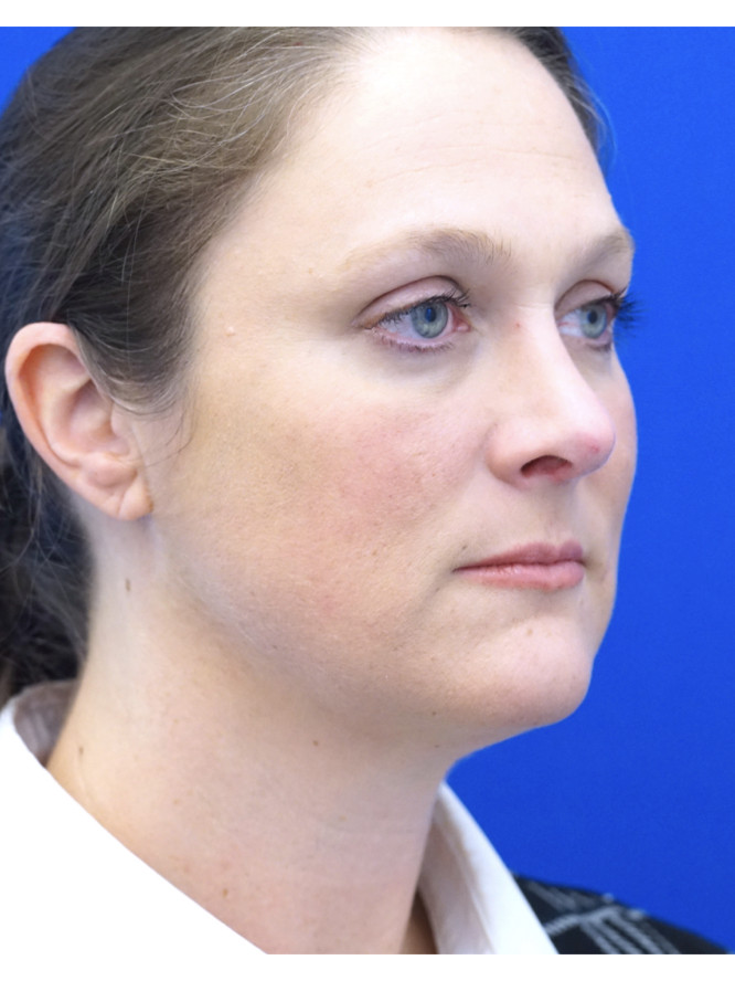 Nasal Profile Femininity — After