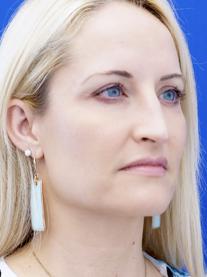 Trichophytic Browlift — Before