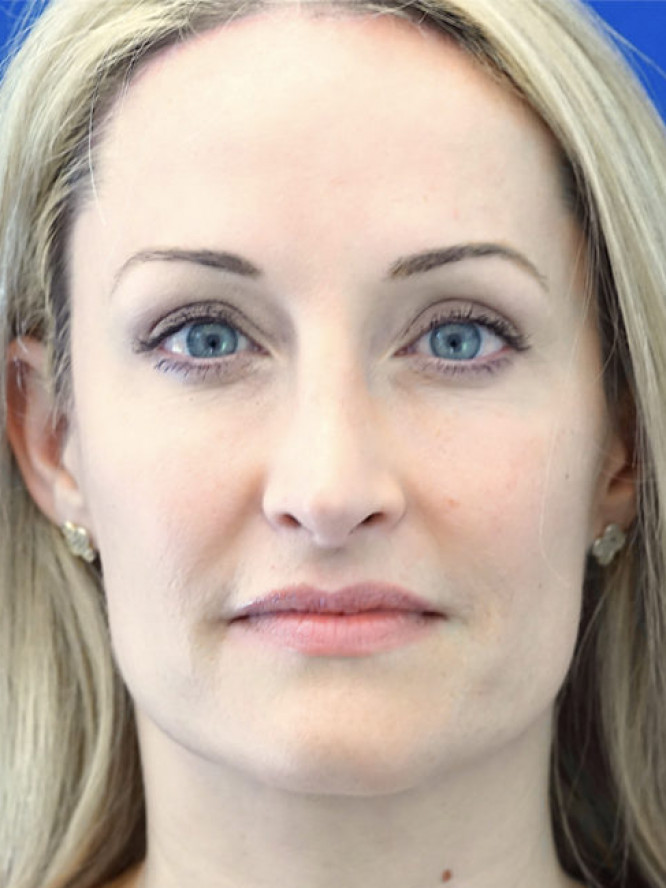 Trichophytic Browlift — After