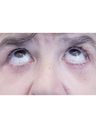Lower Eyelid Fat Reposition — After