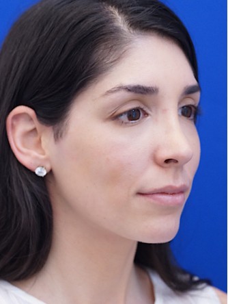 Nasal Bridge Bump* — After