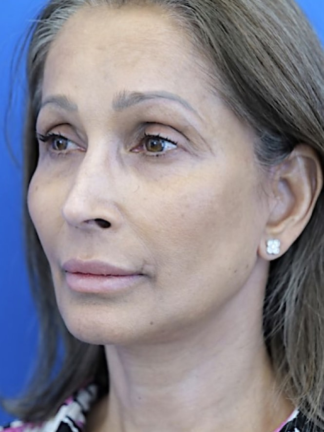 Face and Endobrow Lift — After