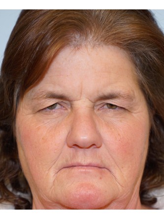 Brow Droop & Upper Eyelid Skin Excess* — Before