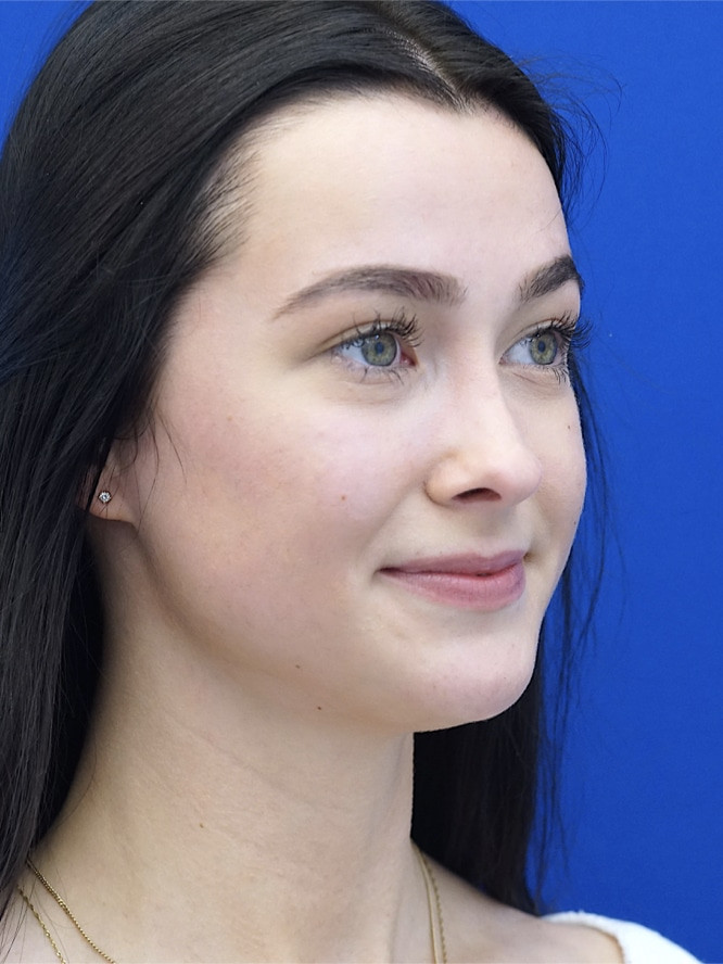 Soften Nasal Bridge — After