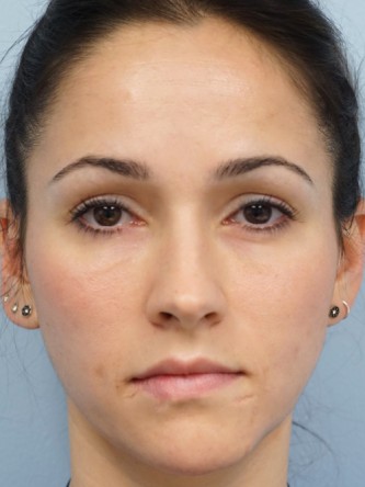 Restylane Silk to Tear Trough – Under Eye* — After