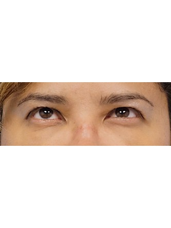 Fat Grafting to Lower Eyelid* — After
