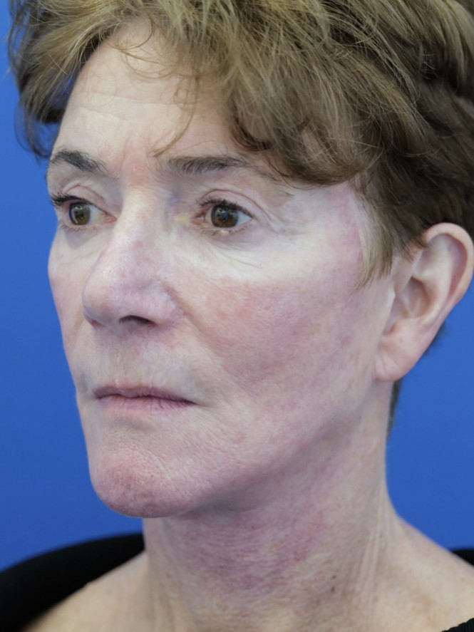 Deep Plane Facelift and Eyelid Lift — After