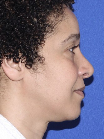 Ethnic Rhinoplasty* — After