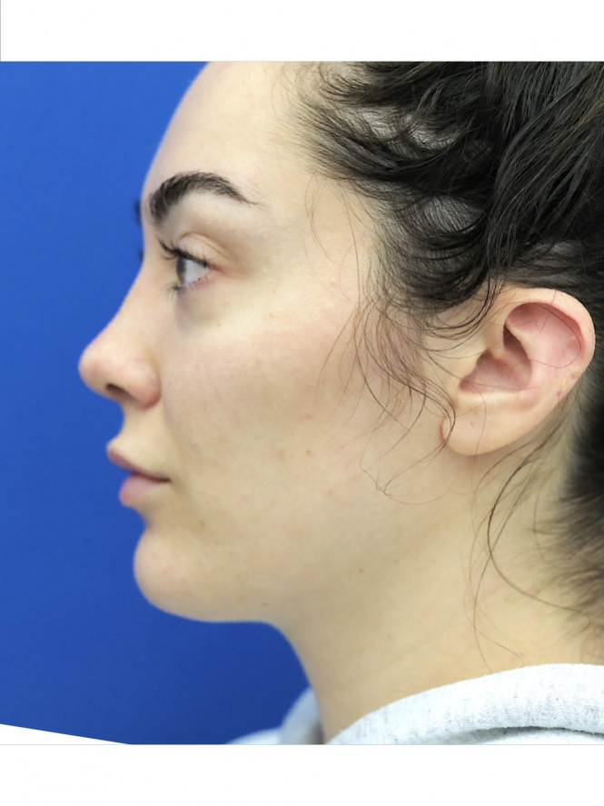 Ideal Nasal Profile — After