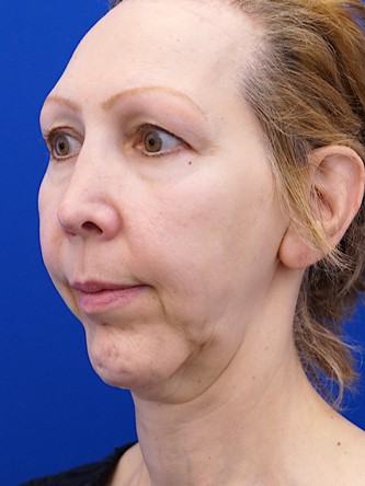 Revision Chin Implant, Mini Lift* — Before
