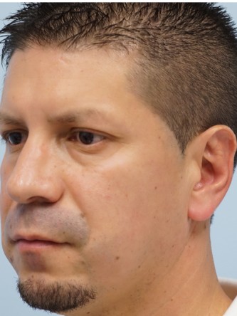 Protruding Ears – Upper Third* — After
