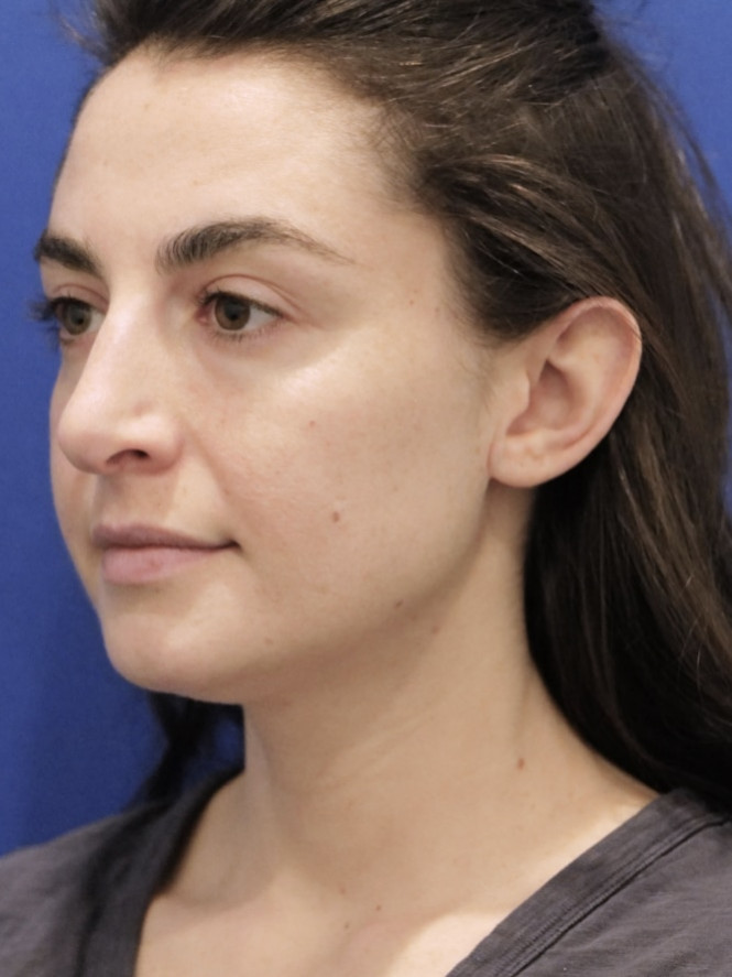 Earlobe Reduction — After