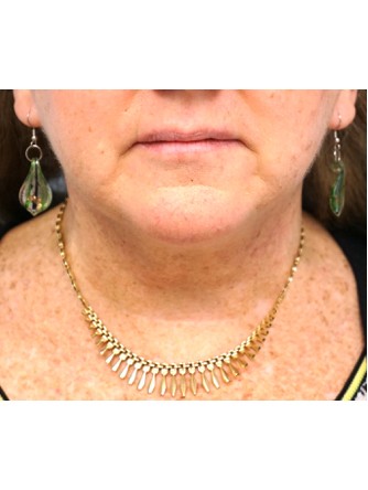 Short Oblique Neck* — After