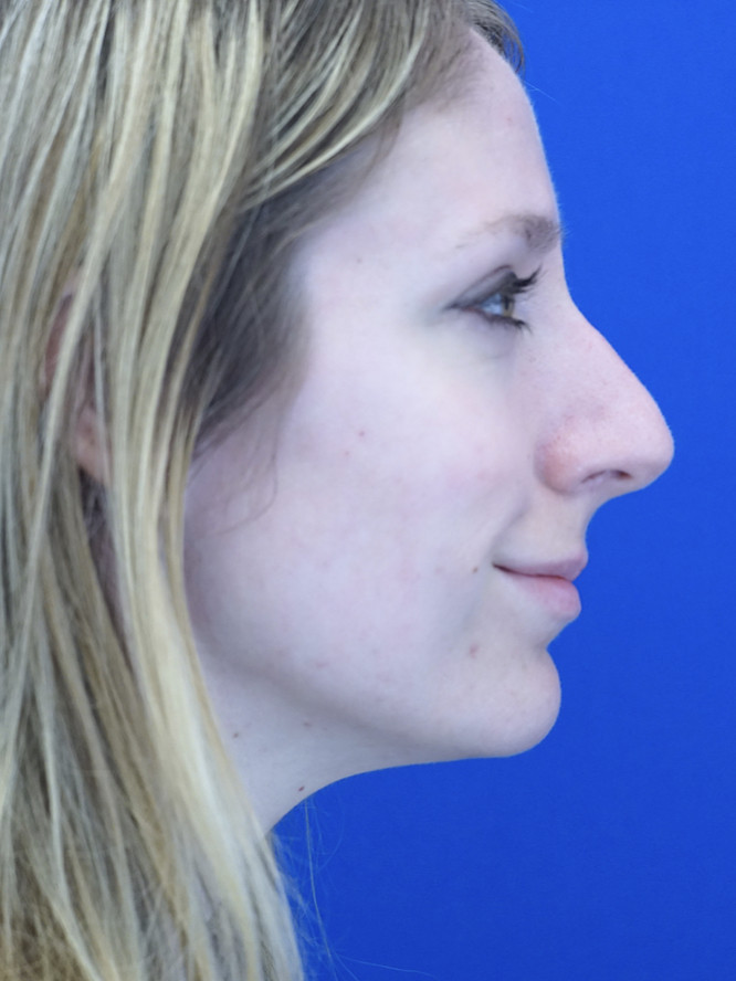 Nasal Profile Finesse — Before