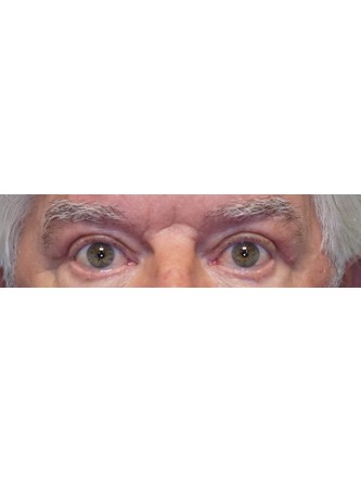 Loose Upper Eyelid Skin* — After