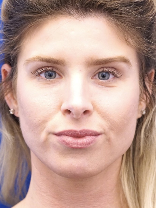 Lower Eyelid Skin Laxity — Before