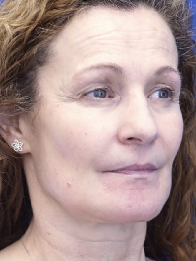 Perioral Volume Loss — After