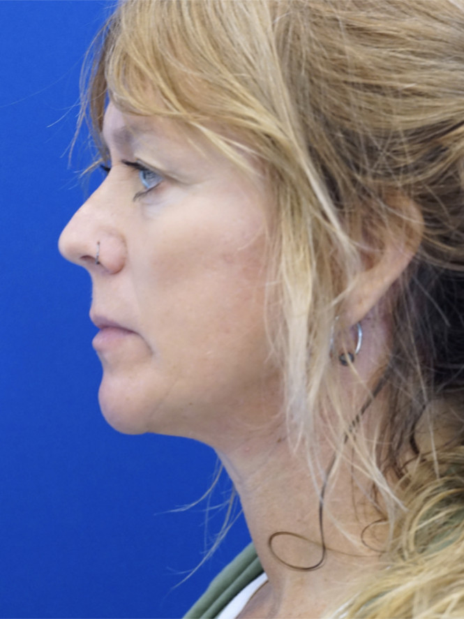 Case 5704: after Fantastic Facial Profile