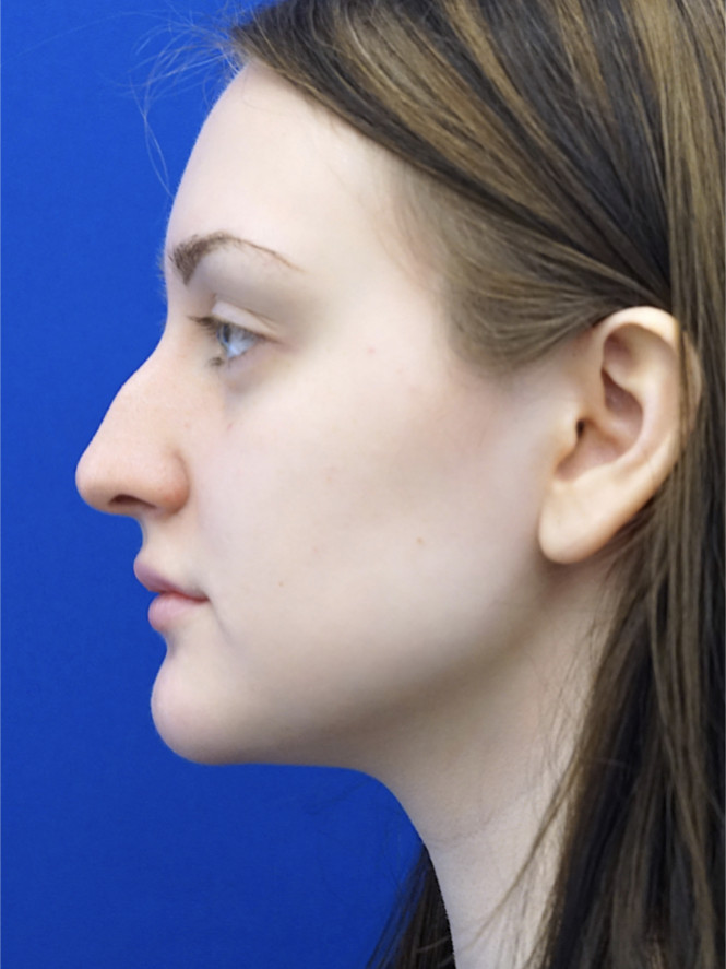 Natural Profile — Before