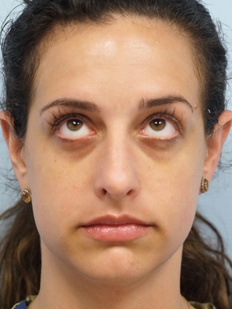 Lower Eyelid Dark Shadow* — Before