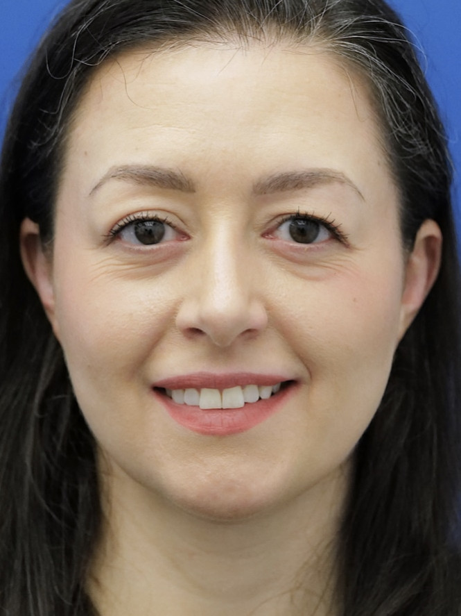 Case 6868: before Brow Fat Suspension