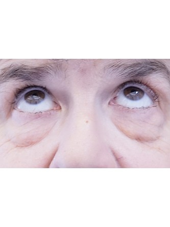 Lower Eyelid Fat Reposition — Before
