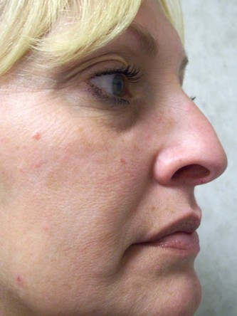 Mild Dorsal Hump & Droopy Tip2* — Before