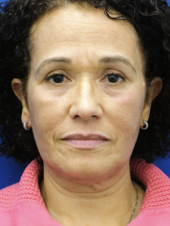 Deep Plane Full Facelift — Before