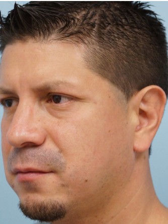 Protruding Ears – Upper Third* — Before