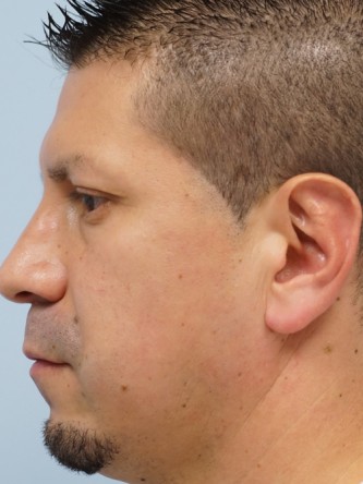 Protruding Ears – Upper Third* — After