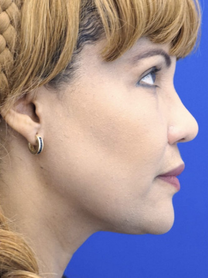 Narrow Widened Nose — After