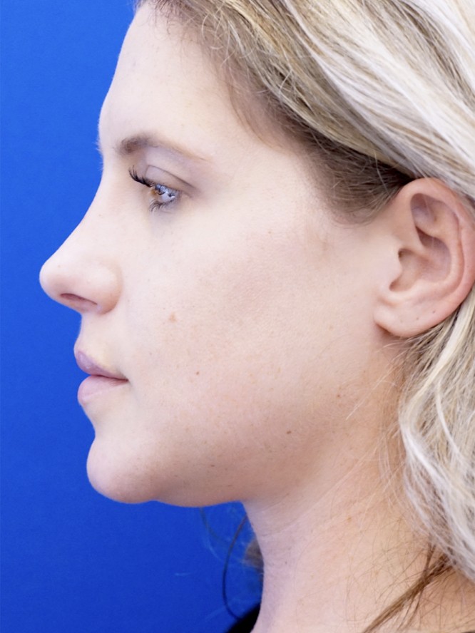 Aesthetic Nasal Profile — After