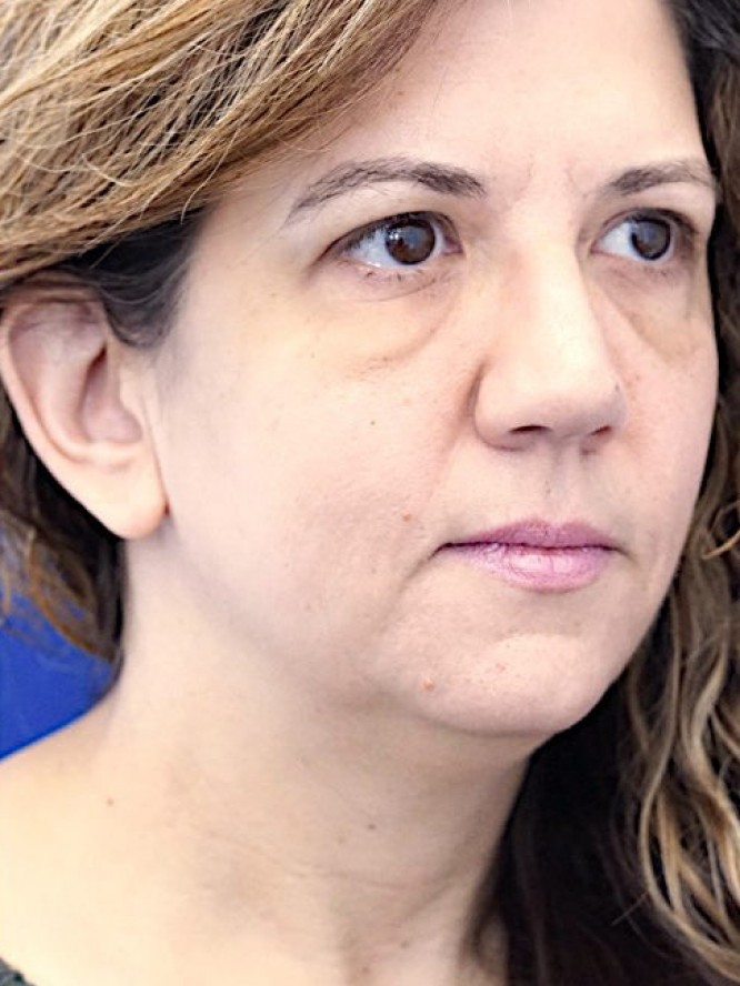 Deep Plane Face Lifting — Before