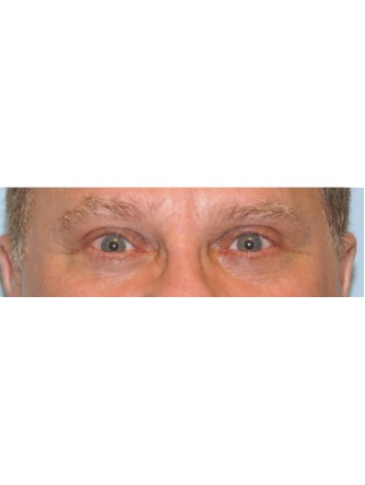 Sleepy Eyes* — After