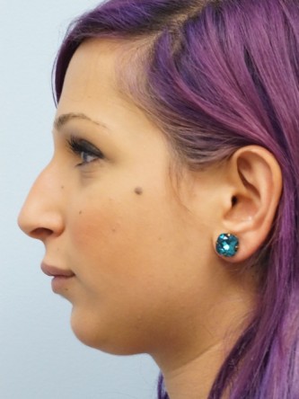 Juvederm Upper and Lower Lip Fillers* — After
