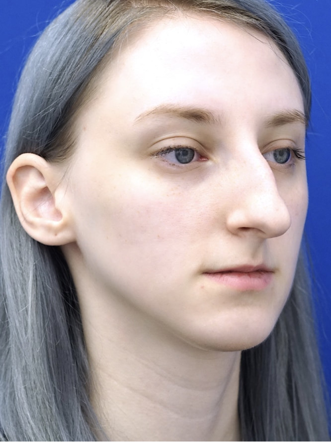 Dorsal Hump and Tension Tip — Before