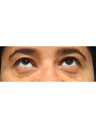 Fat Grafting to Lower Eyelid* — Before