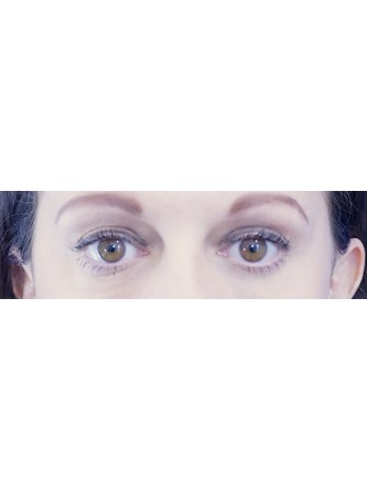 Lower Eyelid Hollow* — After