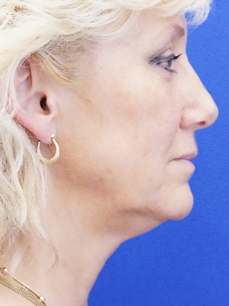 Facelift, Eyelid Skin Trim, Facial Fat Transfer* — Before