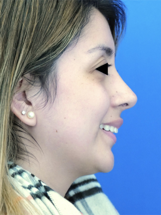 Minimize Tip Droop When Smiling — After
