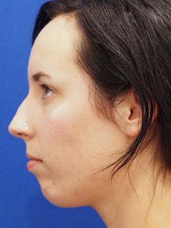Chin Implant and Upper Lip Filler* — Before