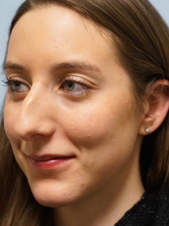 Nasal Hump Endonasal Rhinoplasty* — Before