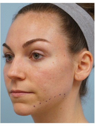 Fractional CO2 Laser Skin Resurfacing1* — Before
