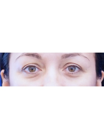 Tear Trough Fillers* — Before
