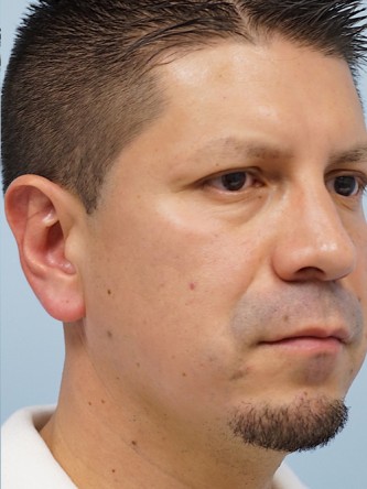 Protruding Ears – Upper Third* — After