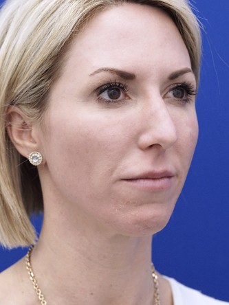 Aesthetic Nasal Contour* — Before