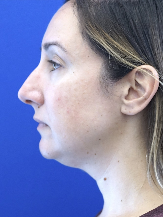 Chin and Neck Definition — Before