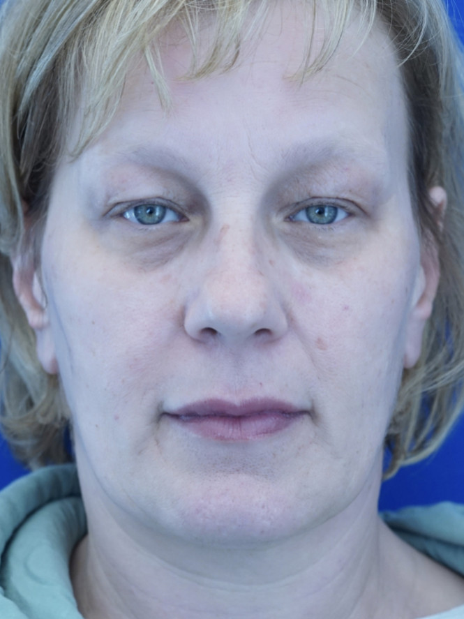 Upper Eyelid Rejuvenation — Before