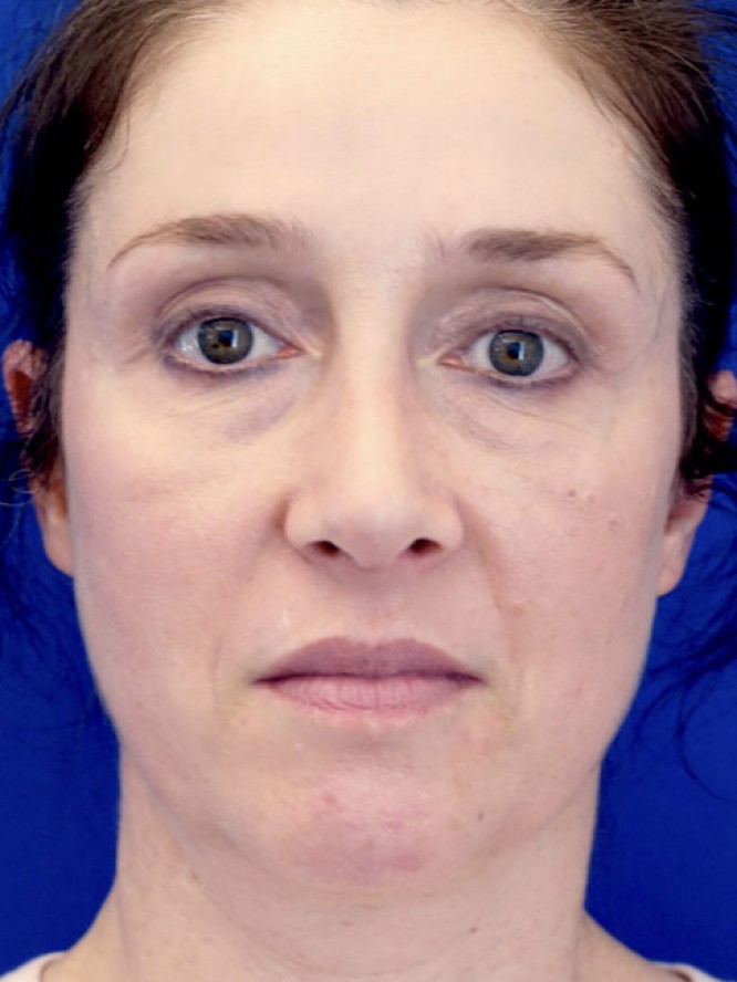 Nasal Aesthetic Nuances — After